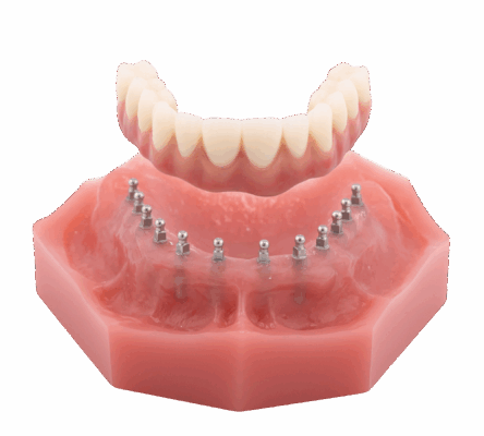 Full-Arch Dental Implants in Denver, CO | Book a Free Consultation
