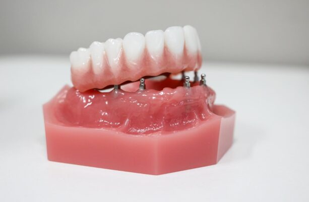 Implant Dentures in Denver, CO | Book a Free Implant Consultation